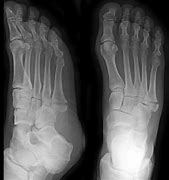 Image result for Jones Fracture 5th Metatarsal