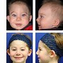 Image result for Metopic Craniosynostosis