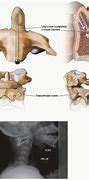 Image result for Anterior C2 Odontoid Screw Placement