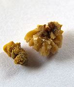 Image result for Kidney Stone Crystals