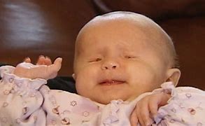 Image result for Brain Baby Born without Eyes