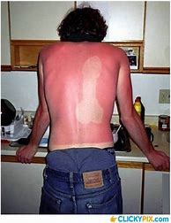 Image result for Bad Sunburn Funny