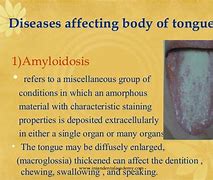 Image result for Localized Amyloid On Tongue