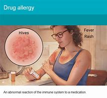 Image result for Sulfa Allergy