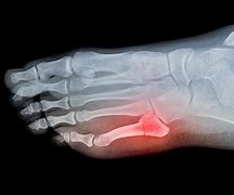 Image result for Jones Fracture