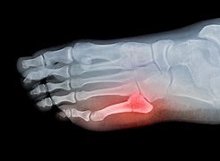 Image result for Broken Foot Jones Fracture