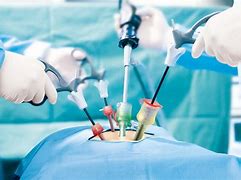 Image result for Laparoscopic Surgery