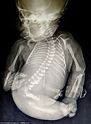 Image result for Baby Born with Mermaid Syndrome