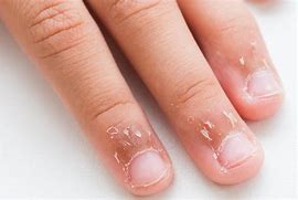 Image result for Skin Lesions On Fingers