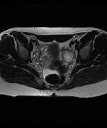Image result for Ovarian Dermoid MRI Radiology