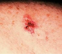 Image result for Basal Cell Carcinoma Skin Cancer On Leg