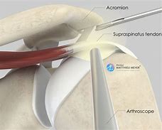 Image result for Right Shoulder Arthroscopy