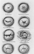 Image result for Abnormal Cervix Appearance