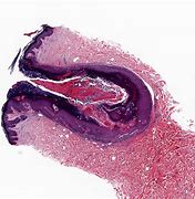 Image result for Warty Dyskeratoma