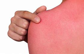 Image result for Sunburn On Shoulders