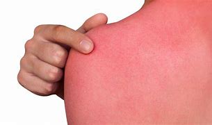 Image result for SunBurn Rash