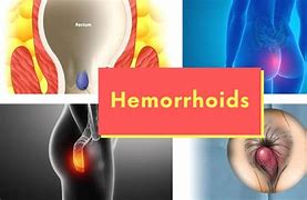 Image result for hemorroide