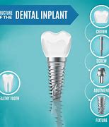 Image result for Dental Implant Graphic