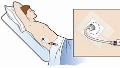 Image result for Biliary Drain Dressing