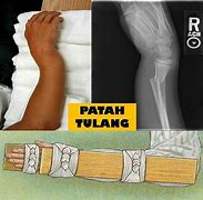 Image result for Lengan Tulang Patah