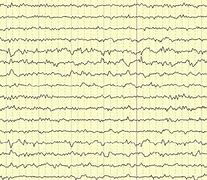 Image result for EEG Phatomy Spikes