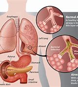 Image result for Cystic Fibrosis