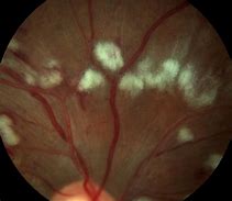 Image result for Cotton-Wool Spots Retina