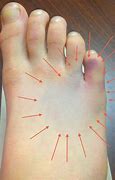 Image result for Metatarsal Bruise