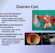 Image result for Sinister Ovarian Cyst Ultrasound
