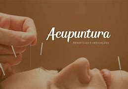 Image result for acupuntira