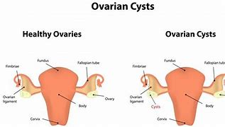 Image result for 3 Cm Ovarian Cyst