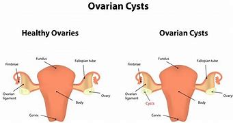 Image result for Physiologic Ovarian Cyst