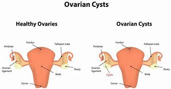 Image result for Ovarian Cyst Pictures
