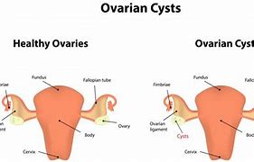 Image result for Right Ovarian Cyst