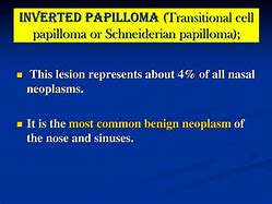 Image result for Nasal Papilloma