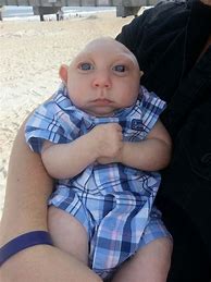 Image result for Born without a Brain Anencephaly