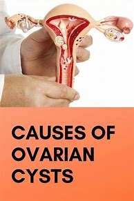 Image result for Ovarian Cyst Types