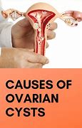 Image result for Ovarian Cancer Tumor Size