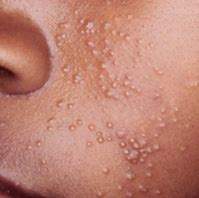 Image result for Molluscum Contagiosum HIV