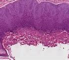 Image result for Molluscum Contagiosum in Tagalog