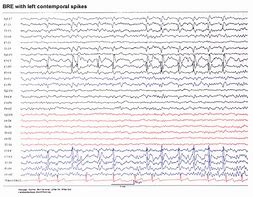 Image result for EEG Spikes