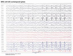 Image result for Large Spikes On EEG