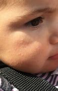 Image result for Keratosis Pilaris Baby