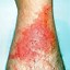 Image result for Poison Ivy Rash Treatment
