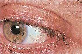 Image result for What Causes Squamous Papilloma