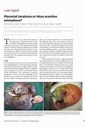 Image result for Placental Teratoma