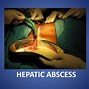 Image result for Abscess Drainage Catheter