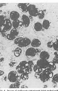 Image result for Molluscum Contagiosum Virus MCV