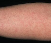 Image result for Virus Skin Rash