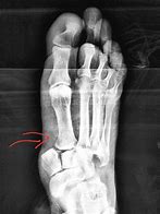 Image result for Homolateral Lisfranc Fracture